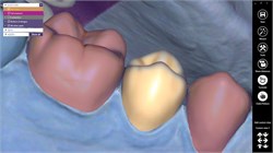 Модуль Exocad Provisional 1859059090