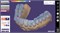 Программное обеспечение Модуль Exocad Bite splint 786210514